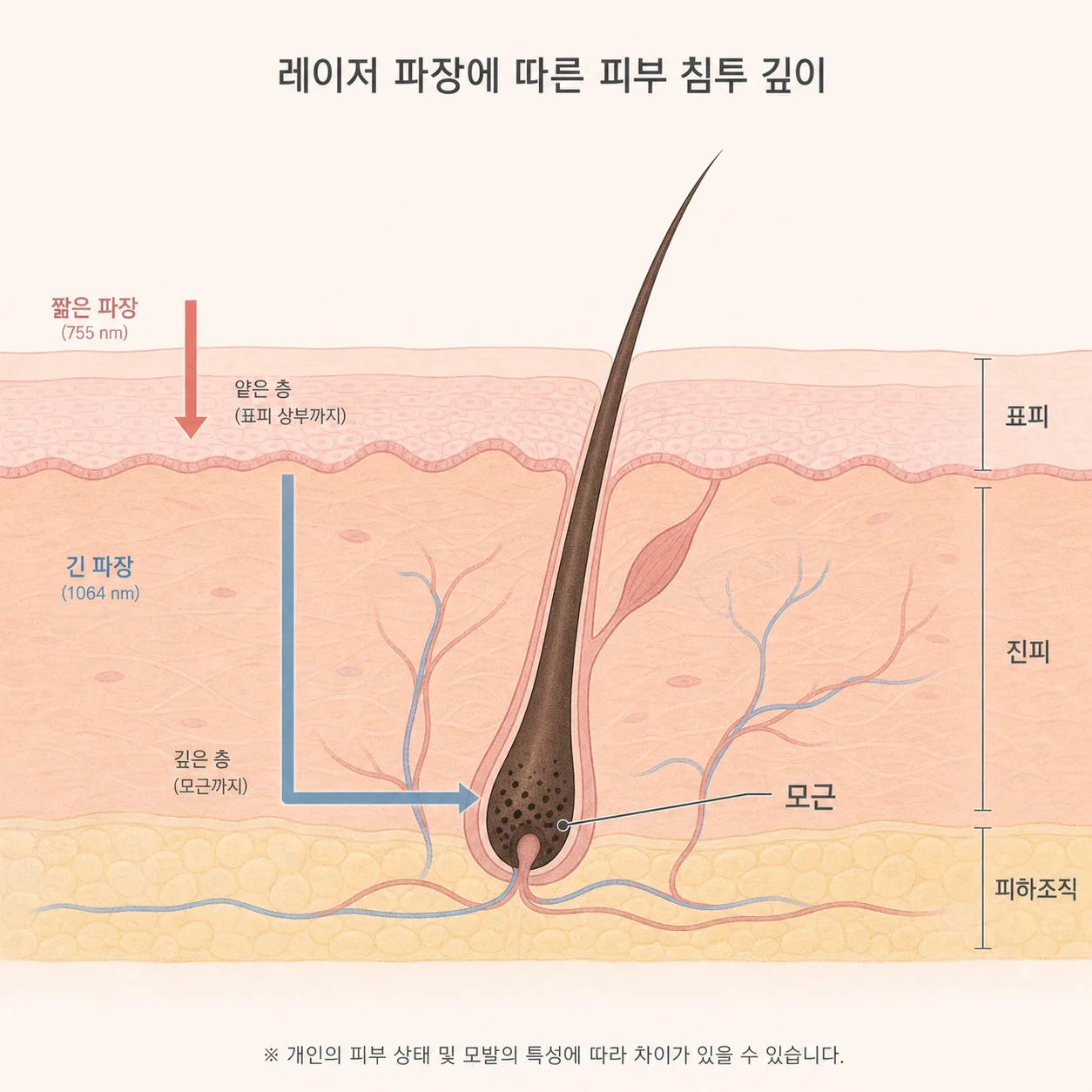 파장에 따라 흡수 깊이가 달라지는 제모 레이저의 원리