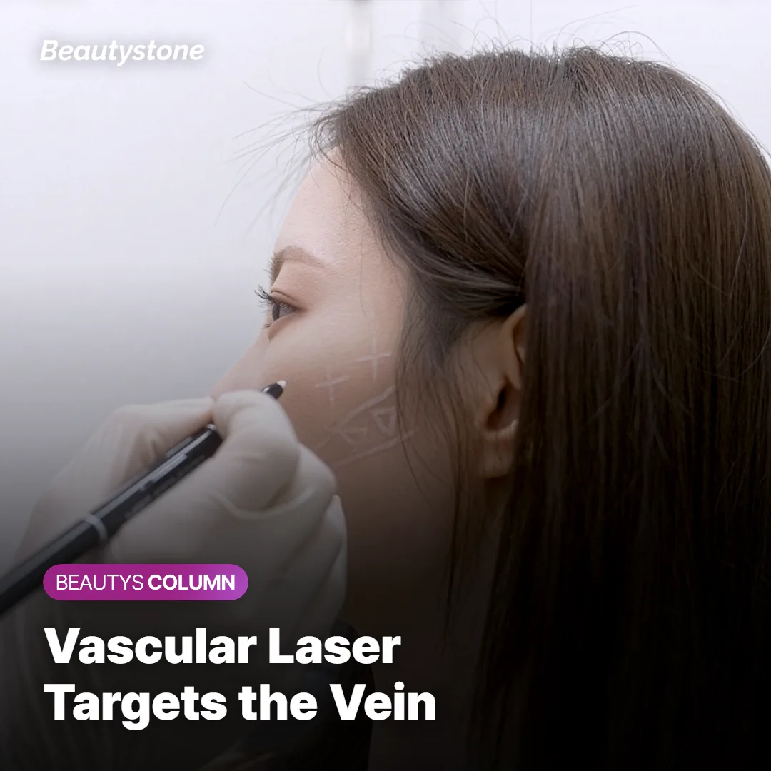 Diagram showing a vascular laser targeting a visible vein under the eye