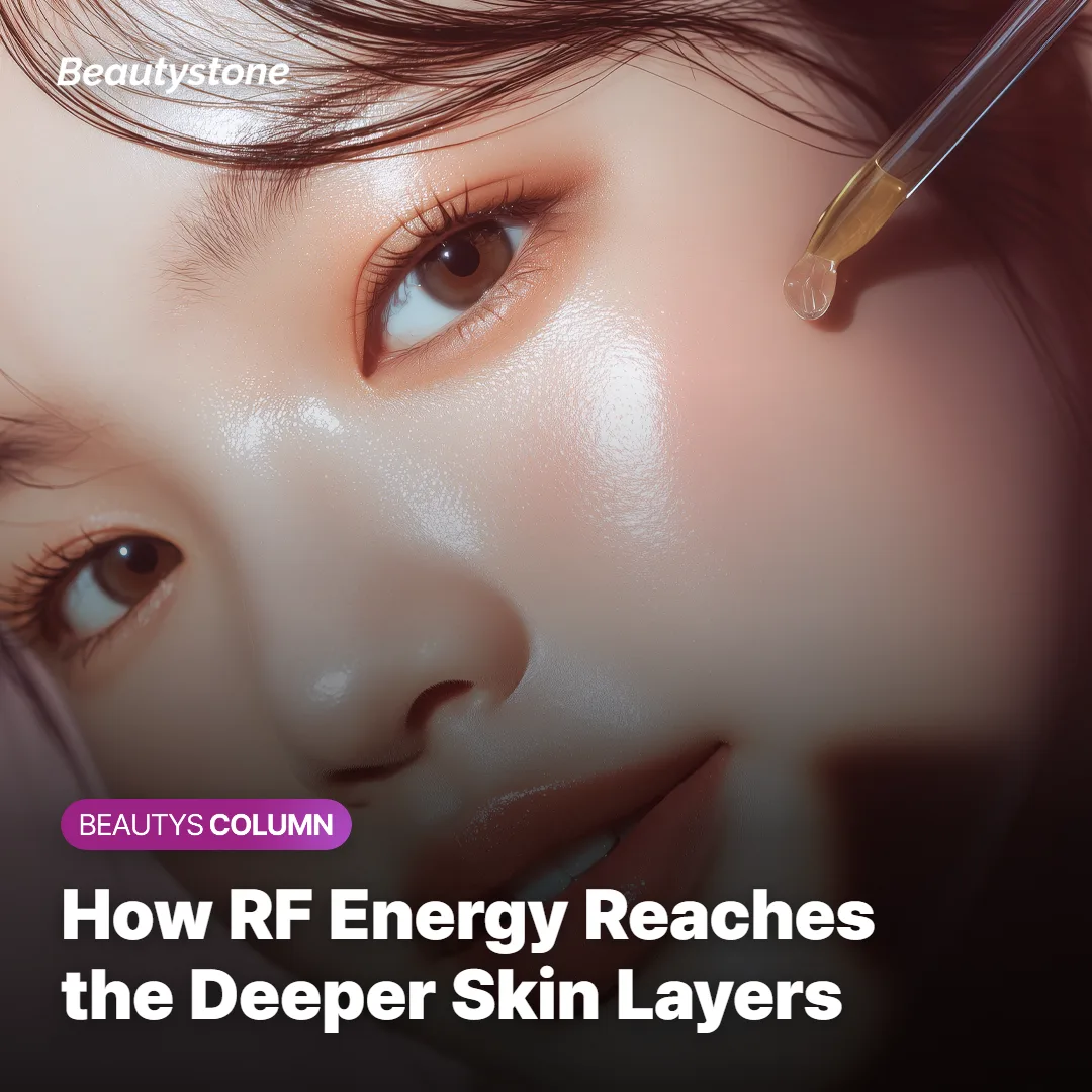 Diagram showing monopolar RF energy traveling from the skin surface down to the SMAS layer