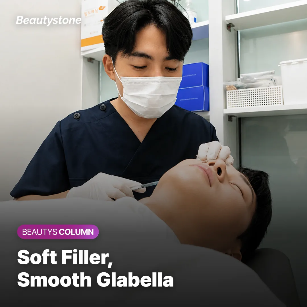 Illustration of soft filler smoothing the glabella between the brows