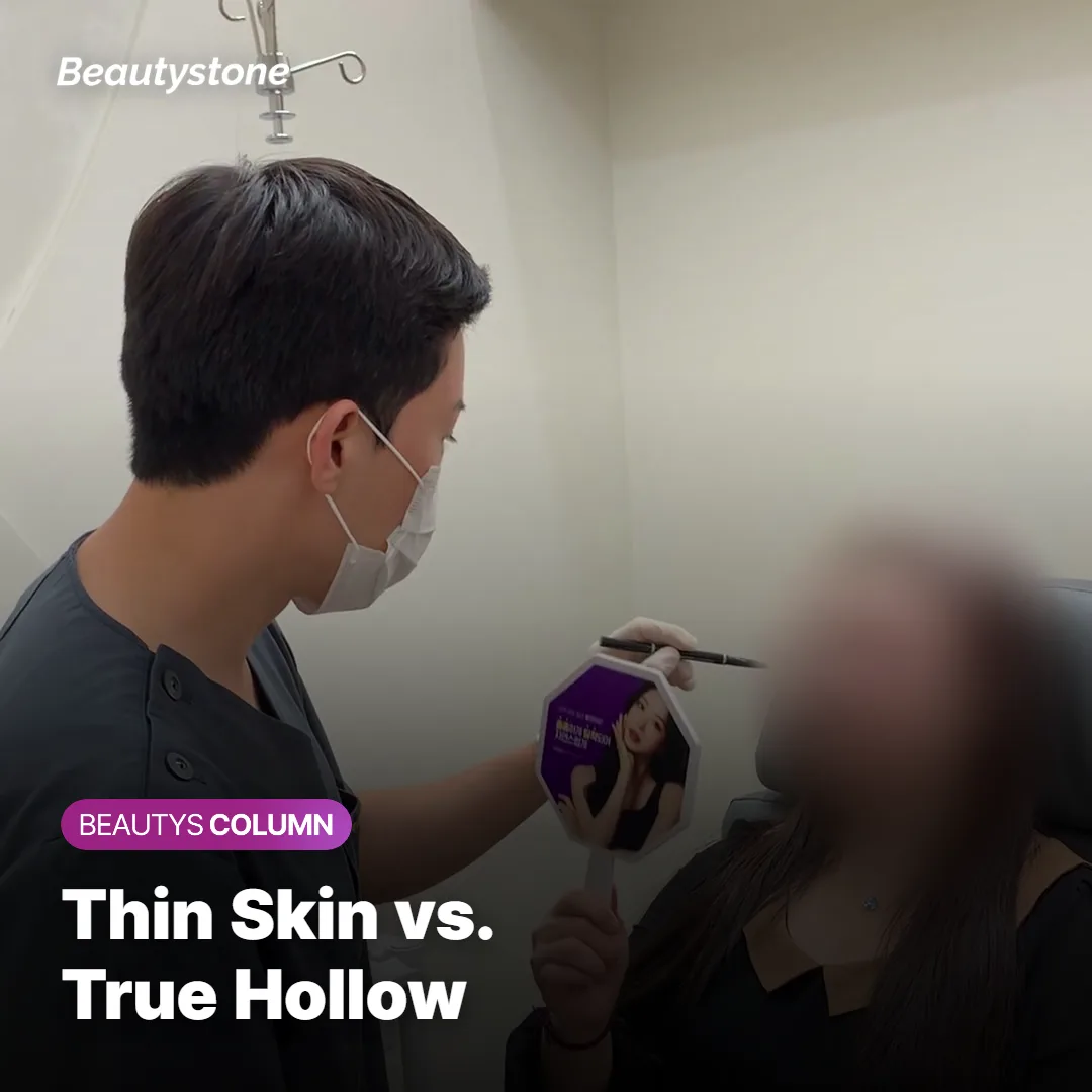 Diagram comparing thin undereye skin with a hollow tear trough