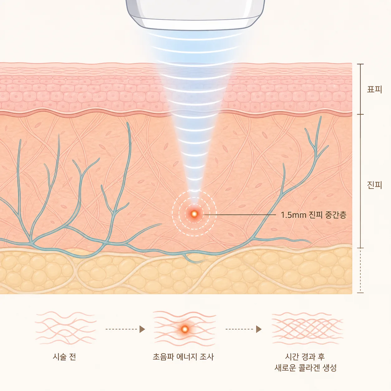 슈링크는 진피 깊은 층에 열을 모아 콜라겐이 서서히 새로 만들어지도록 자극해요.