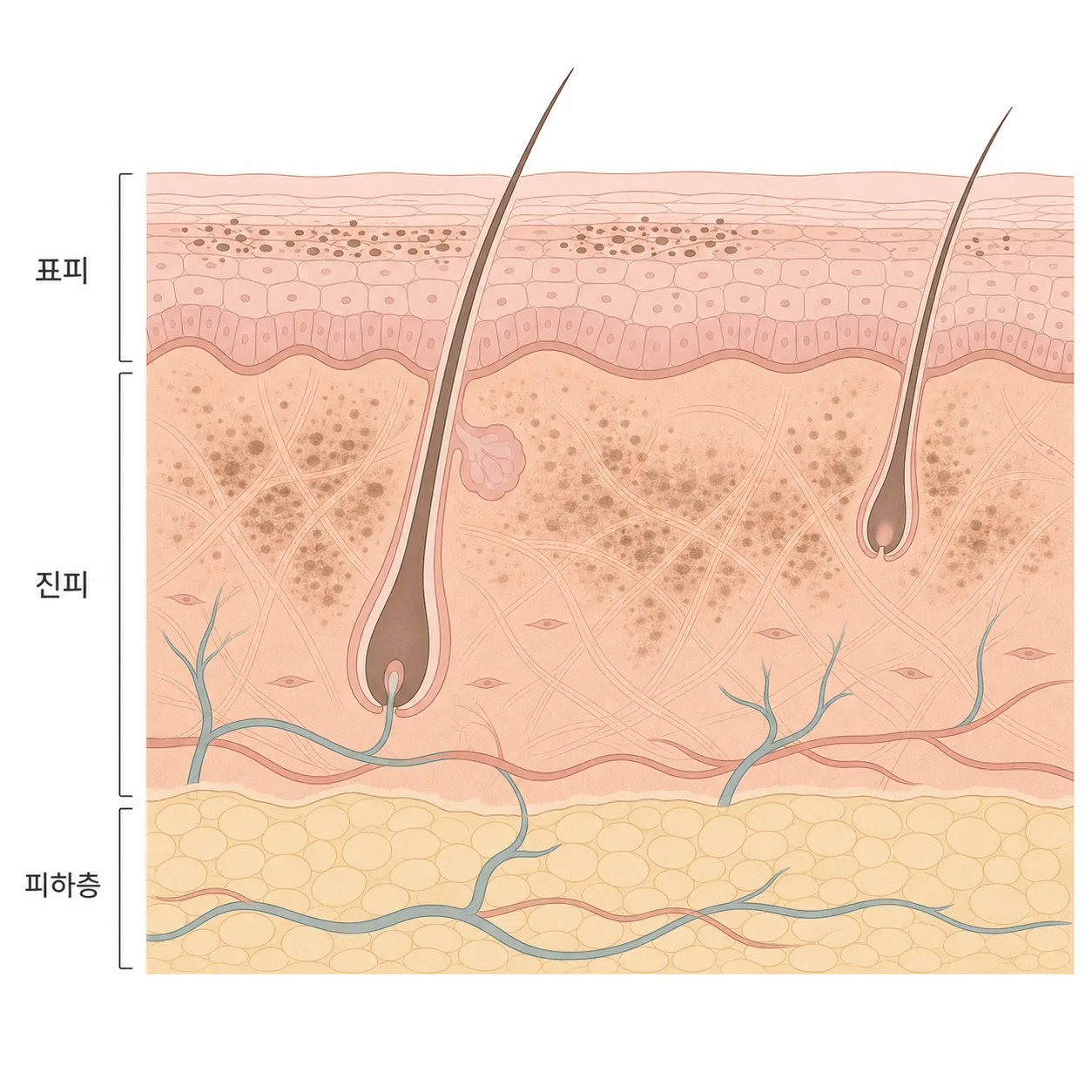 표피에 얕게 자리한 색소와 진피 쪽으로 내려간 색소는 보이는 느낌이 달라요.