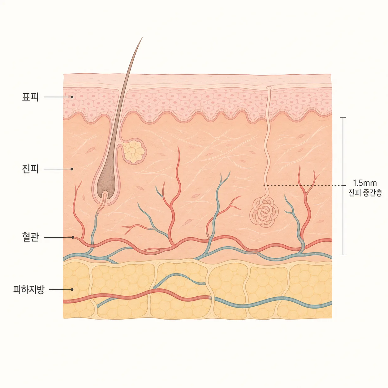 시술 후 진피 속 혈관이 확장된 피부 단면