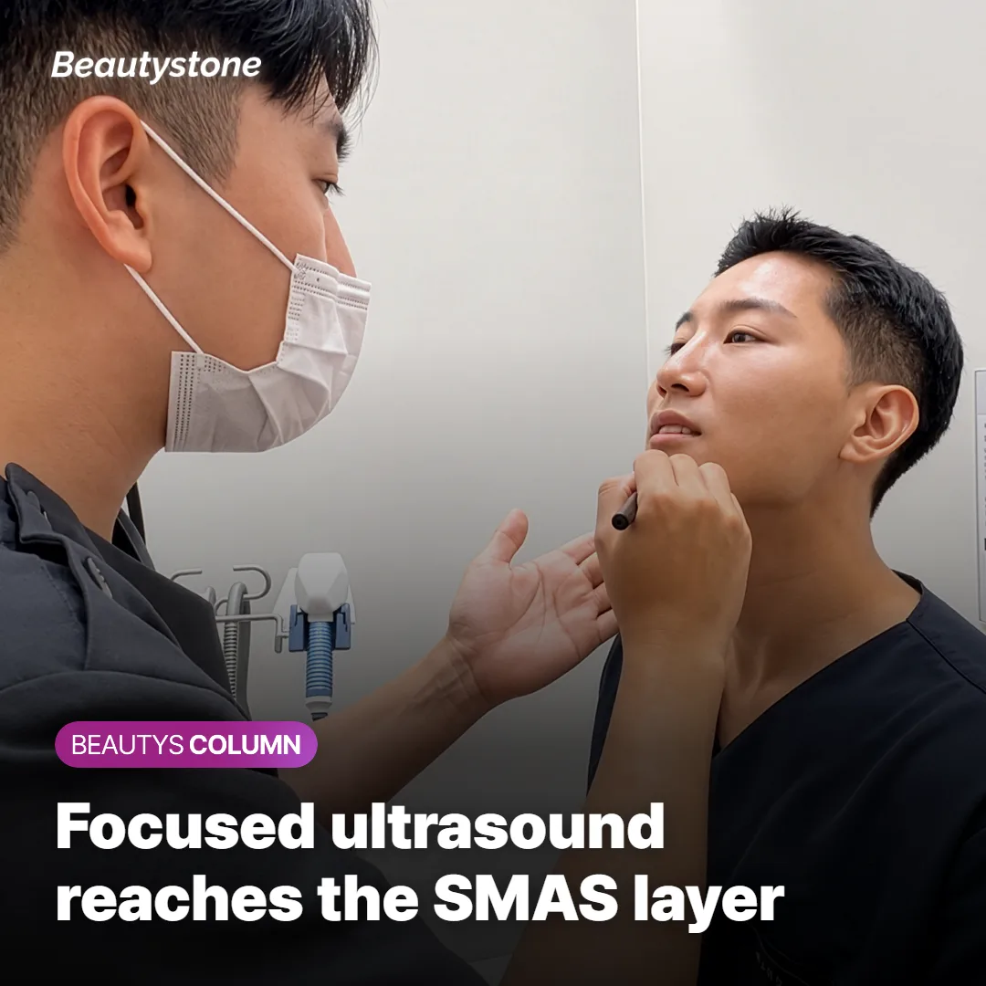 Diagram showing focused ultrasound energy reaching the SMAS layer during Ultherapy treatment