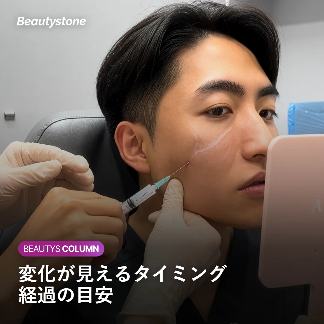 顎ボトックスの効果が見えるまでの経過の目安を示す図