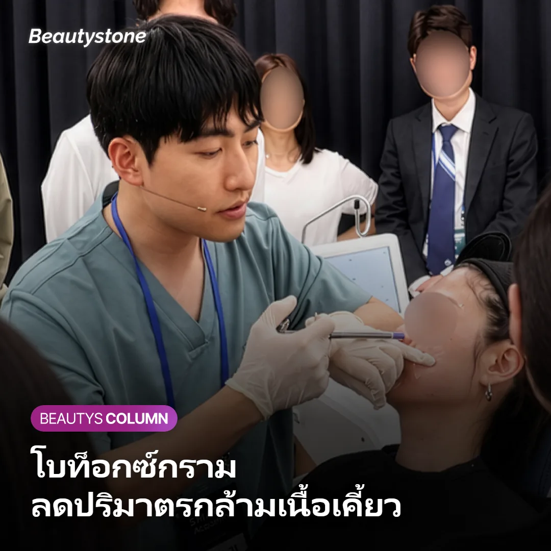 ภาพแสดงตำแหน่งกล้ามเนื้อแมสเซเตอร์ที่ใช้ฉีดโบท็อกซ์ลดกราม