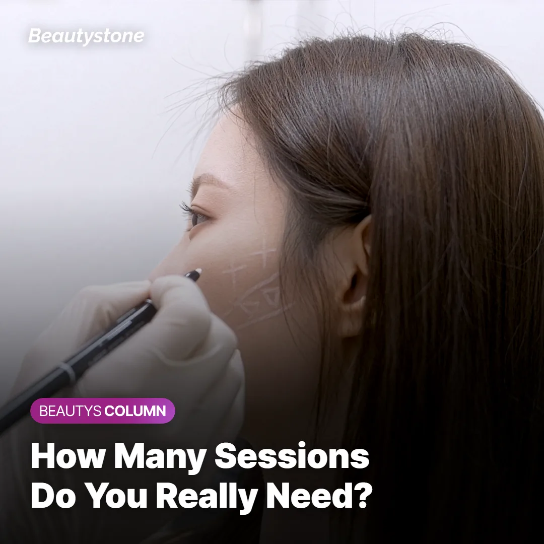 Laser hair removal treatment session using a dual-wavelength device on the skin