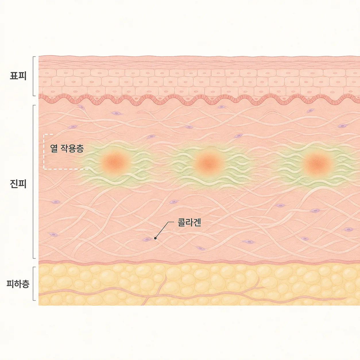 표피를 보존한 채 진피 얕은 층에 작용하는 소프웨이브의 열 작용층