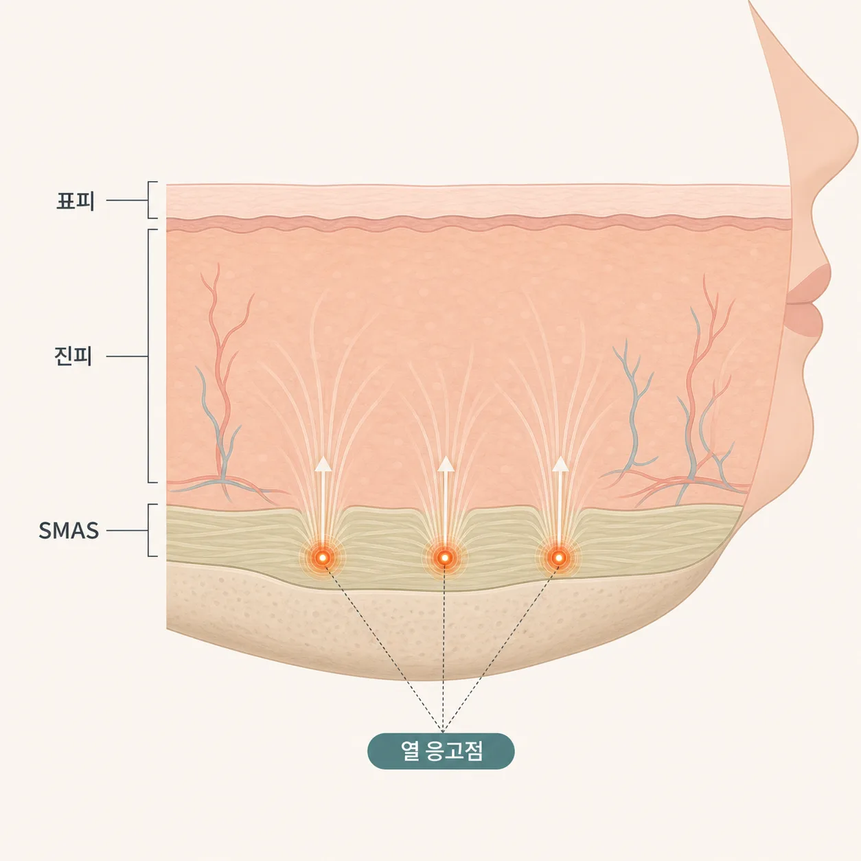 표피를 보존한 채 진피와 깊은 SMAS 층까지 나눠 작용하는 슈링크 유니버스의 열 응고점