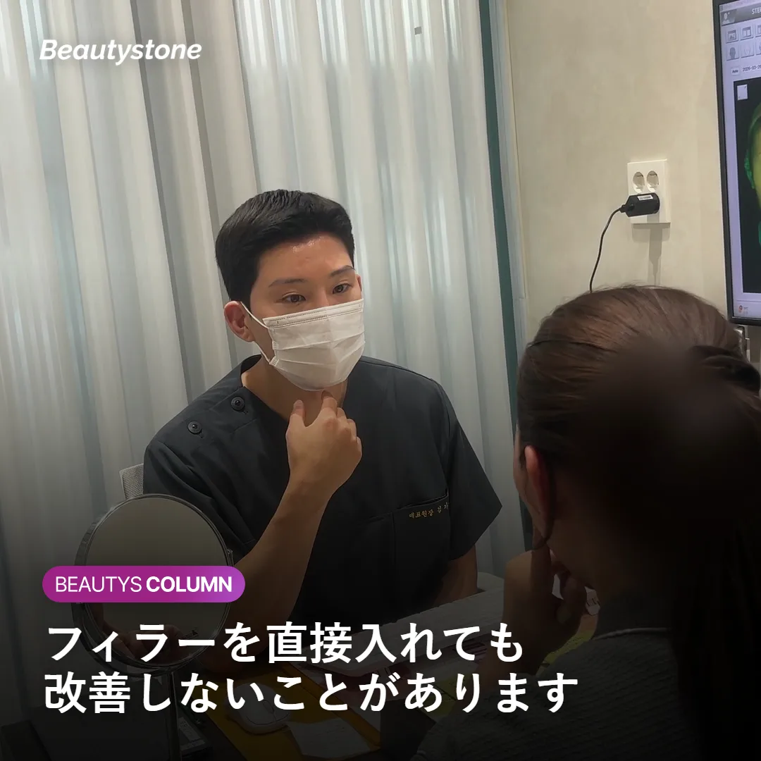 ほうれい線の溝に直接フィラーを入れて膨らんで見える例を示す図