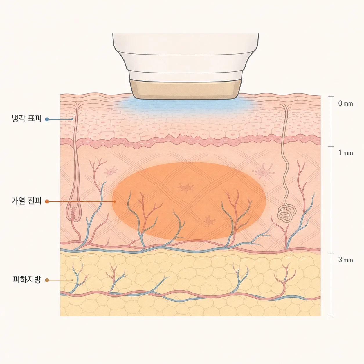 표면은 식히고 진피만 데우는 써마지의 열 분포