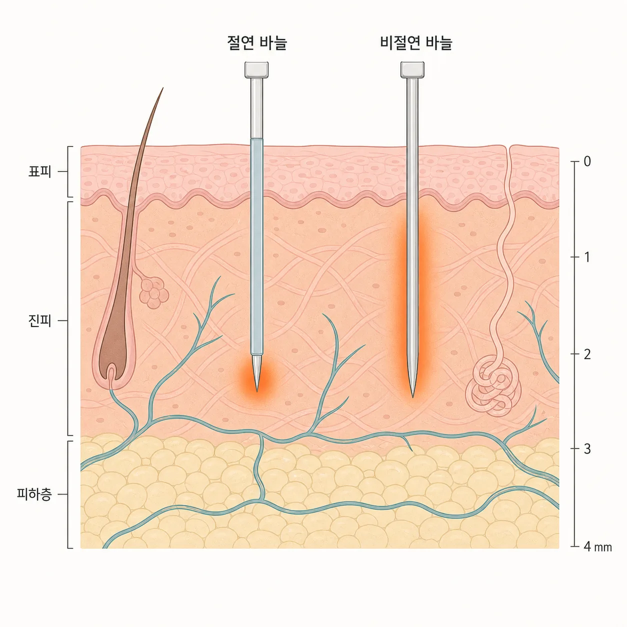 절연·비절연 바늘이 열을 전달하는 깊이 차이