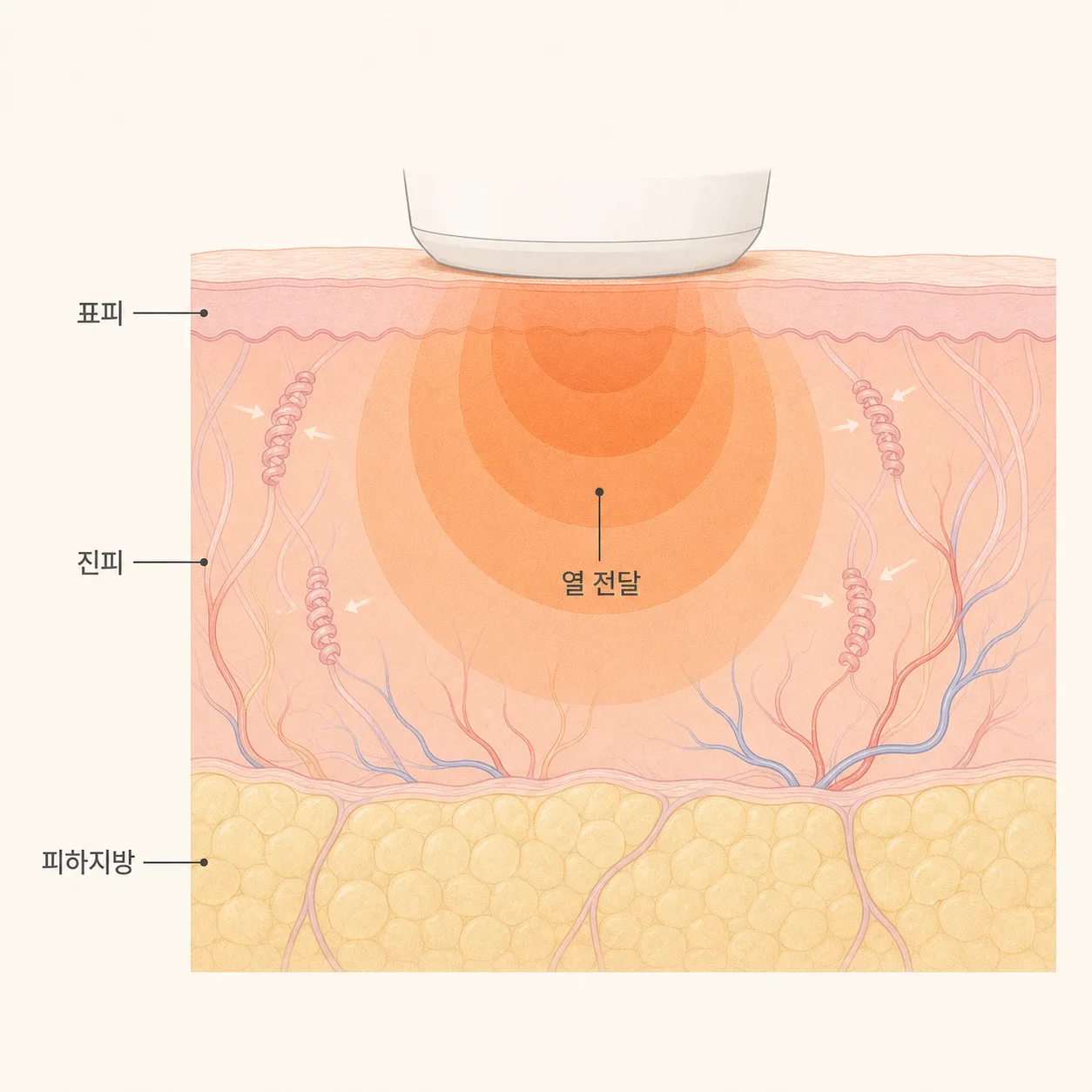 고주파 열이 진피에 넓게 전달되며 콜라겐을 자극해요