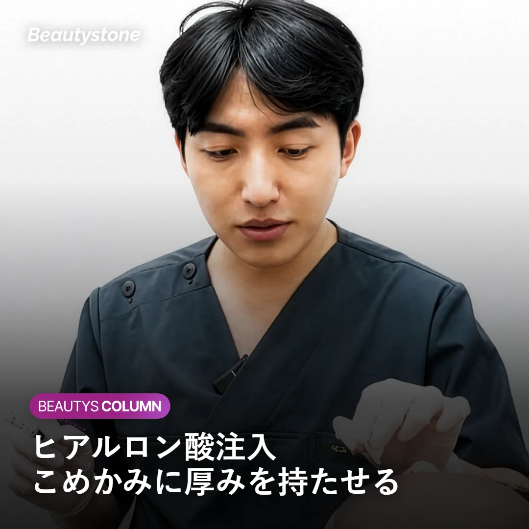 ヒアルロン酸によるこめかみのボリューム補充を示すイメージ