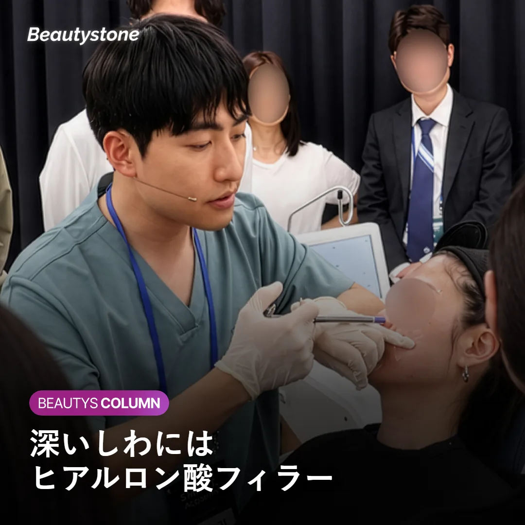 首のヒアルロン酸フィラー注入で深いしわを整える様子を示すイラスト
