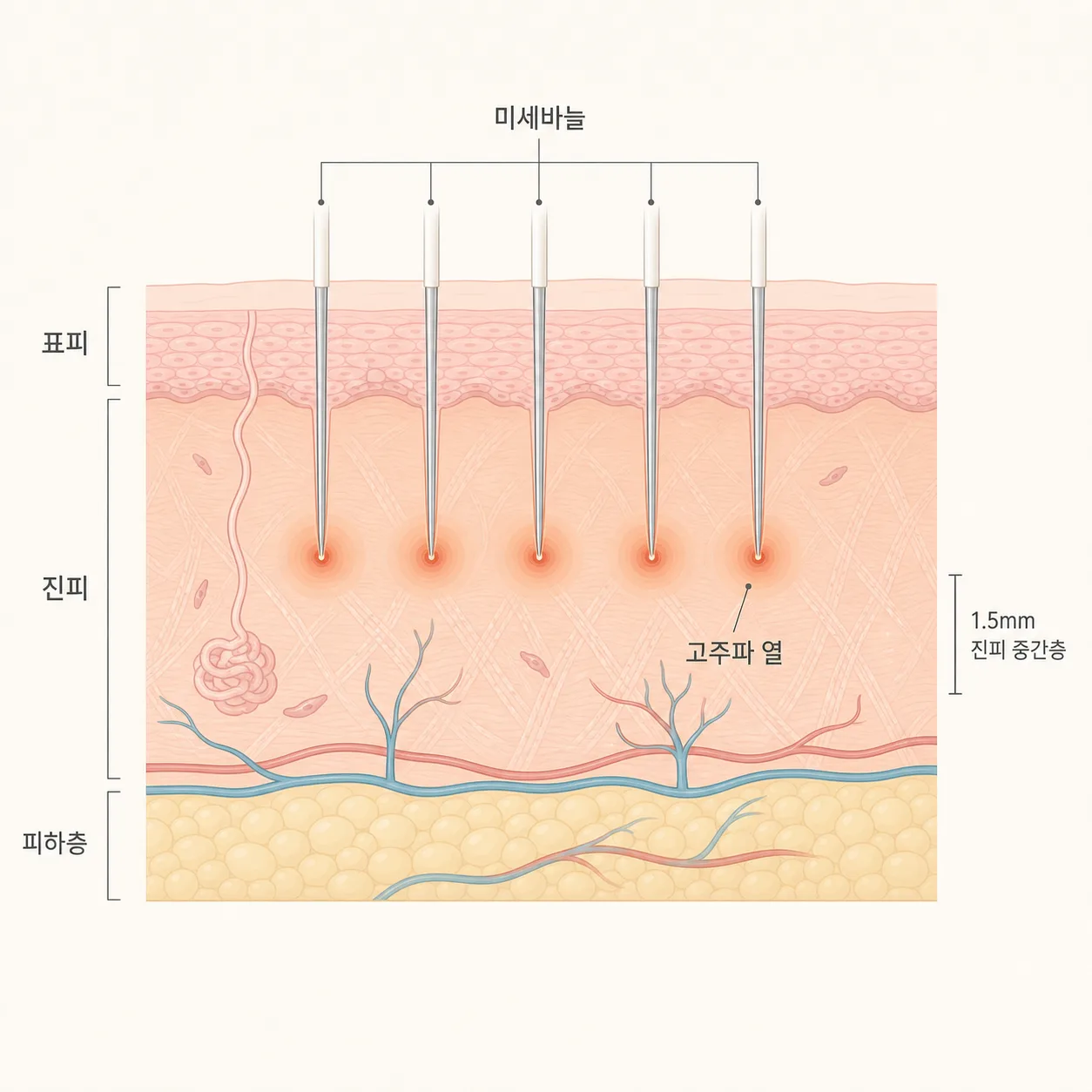 미세바늘이 진피까지 들어가 고주파 열을 전달하는 구조