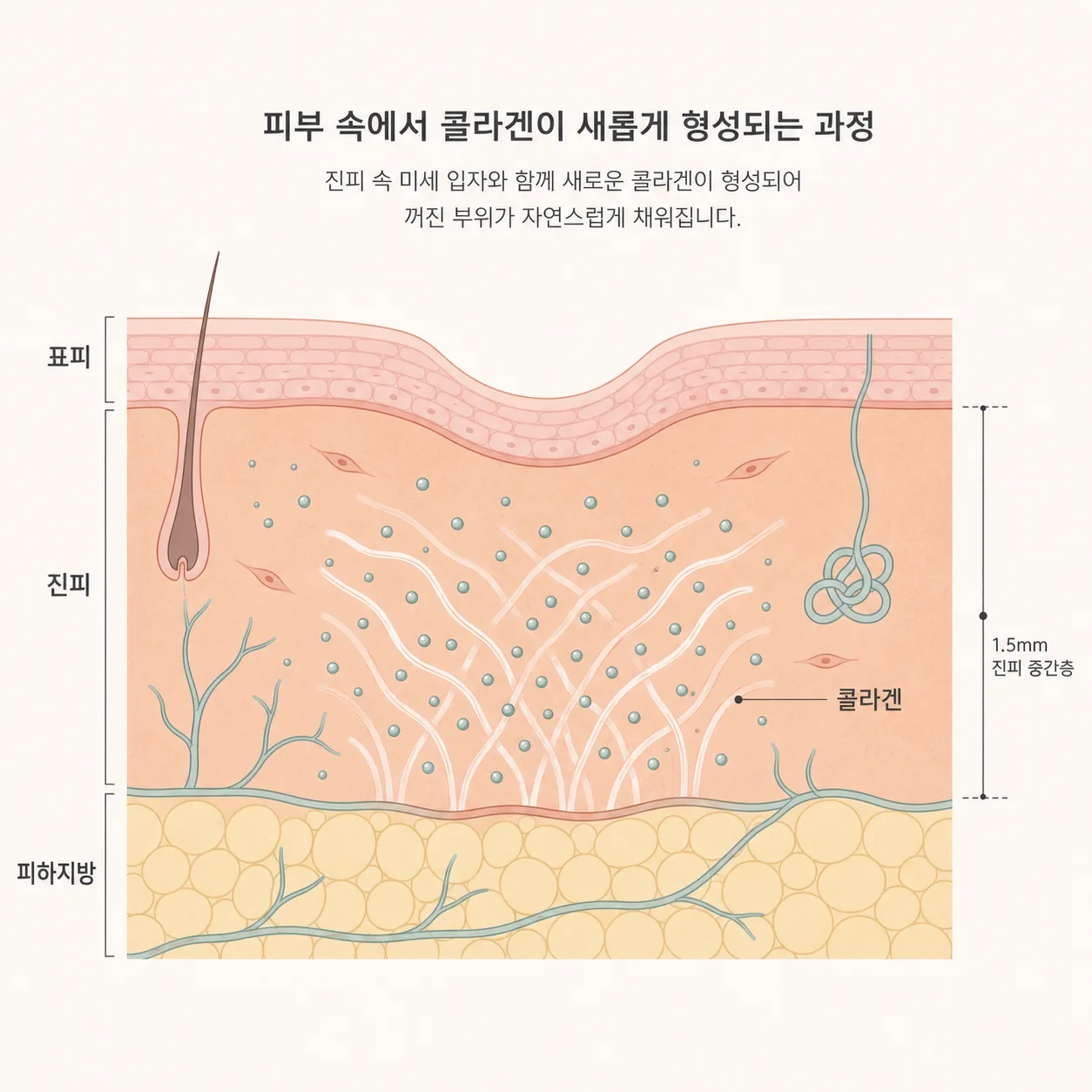 진피에서 새 콜라겐이 차오르며 꺼진 자리를 채우는 구조