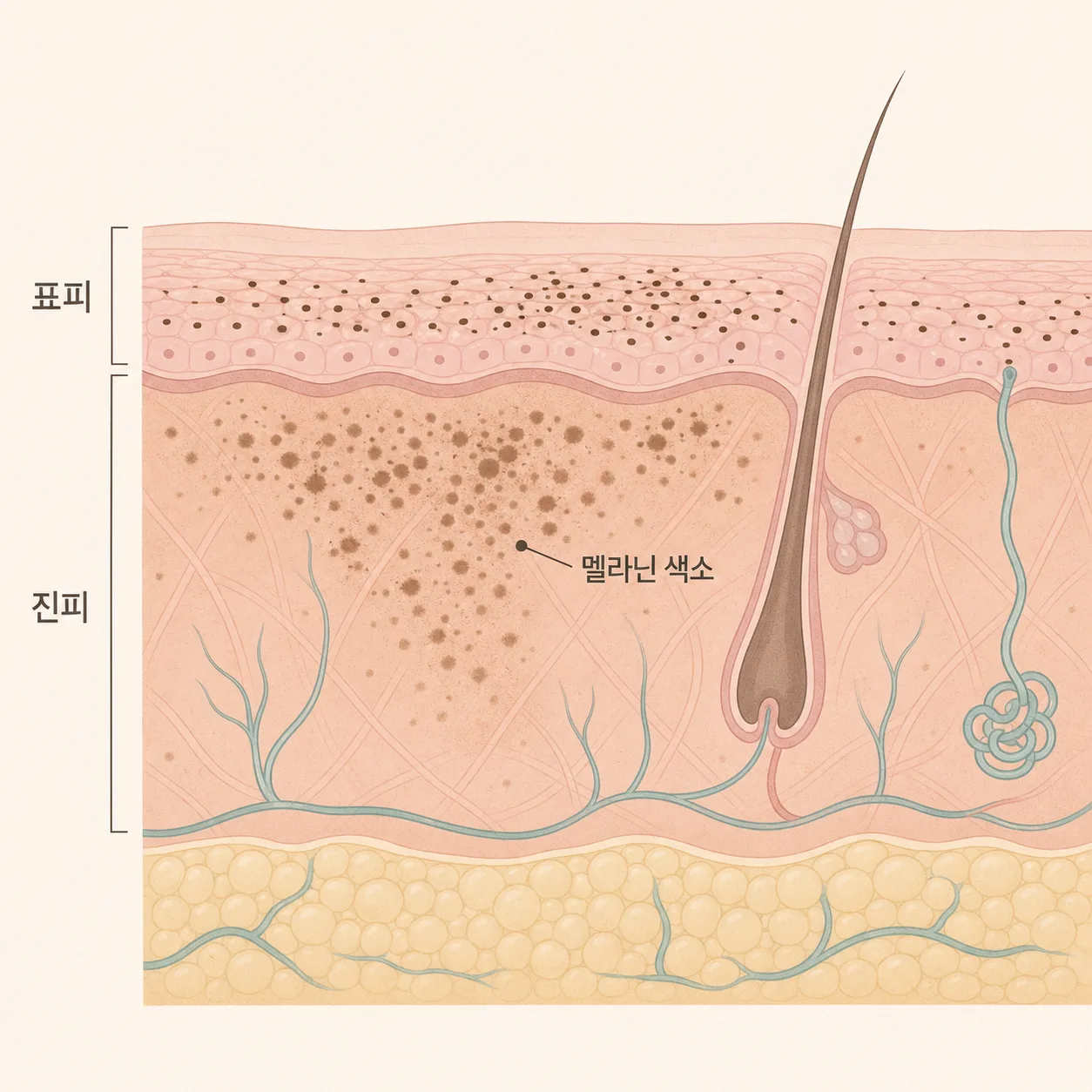 표피에 뭉친 색소와 진피까지 번진 색소의 차이