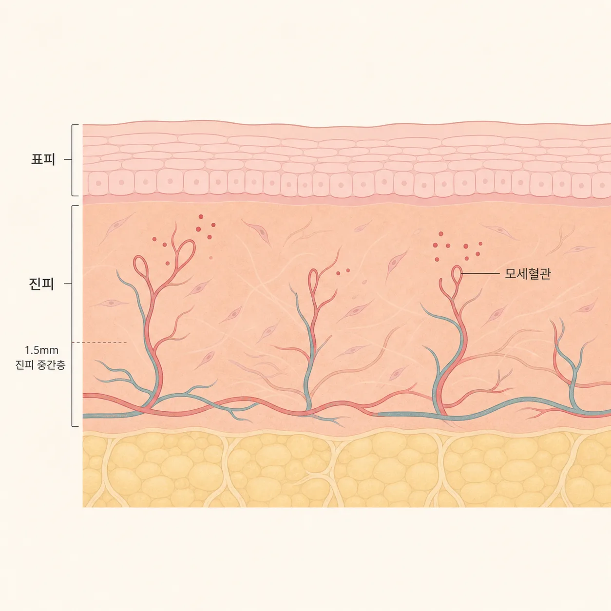 진피 속 모세혈관과 멍·출혈이 쉬워지는 구조