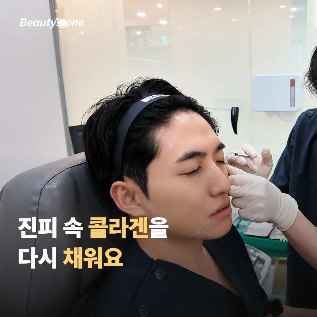포텐자 마이크로니들 RF가 진피에 작동하는 원리