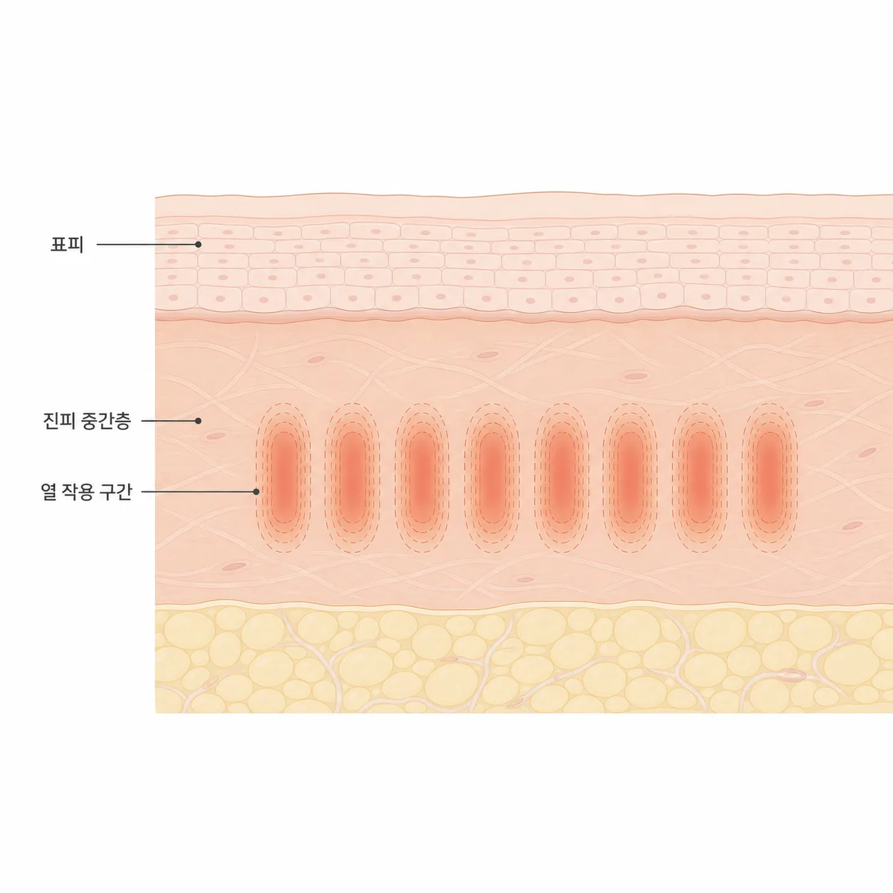 표피를 지나 진피 중간층에 작동하는 열 구간