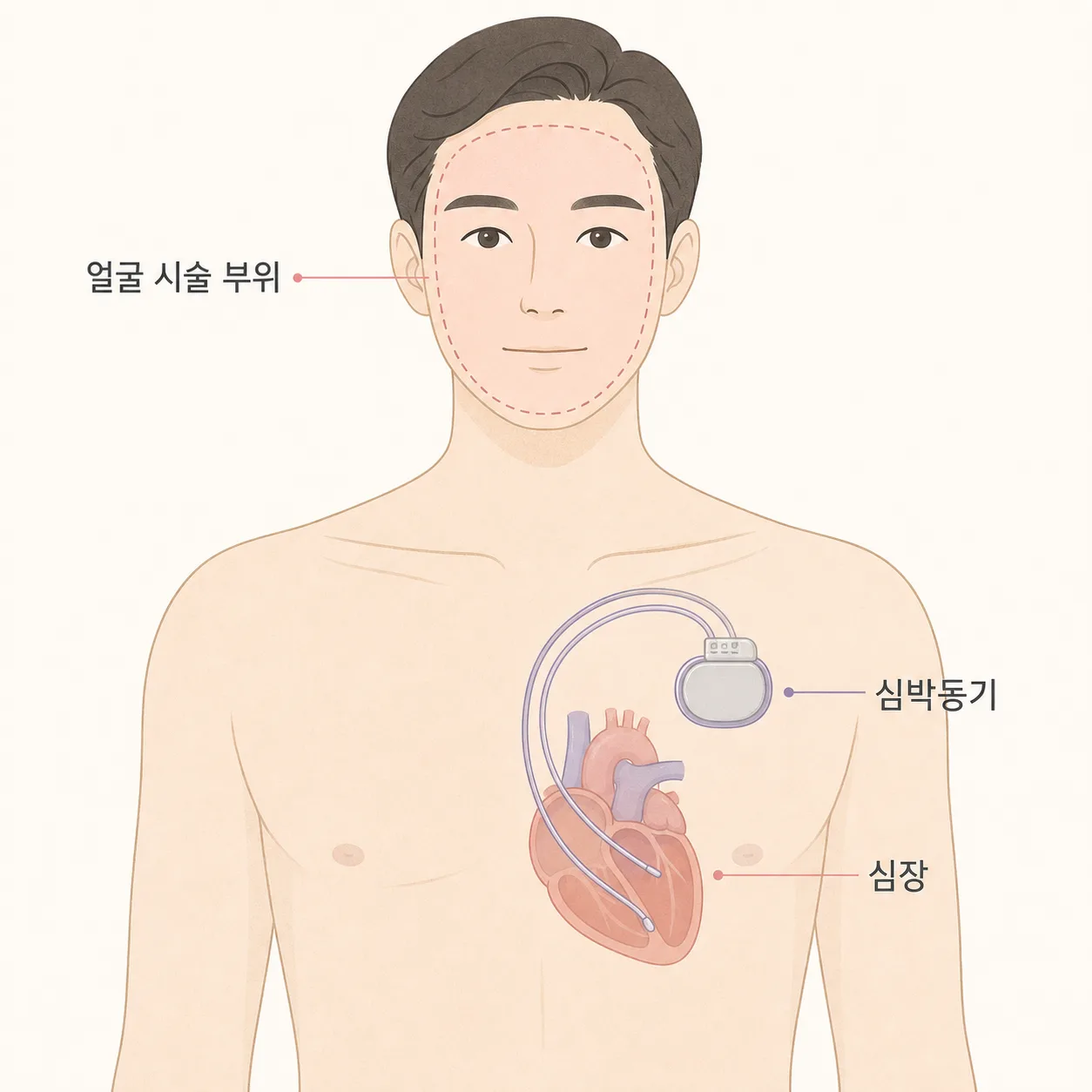 얼굴 시술 부위와 가슴 심박동기의 위치 관계