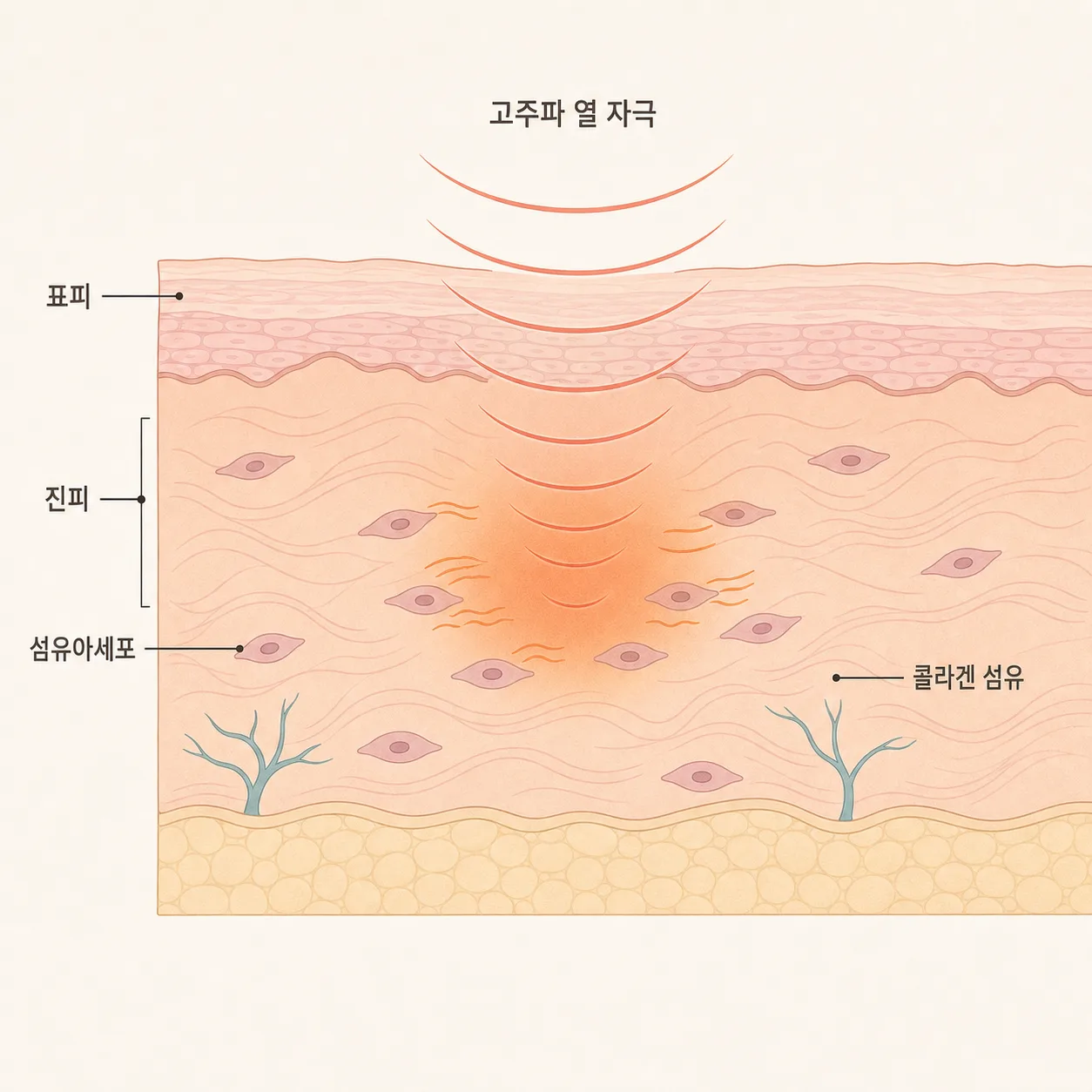 모노폴라 고주파가 진피층 섬유아세포를 자극해 콜라겐 재생을 유도하는 과정