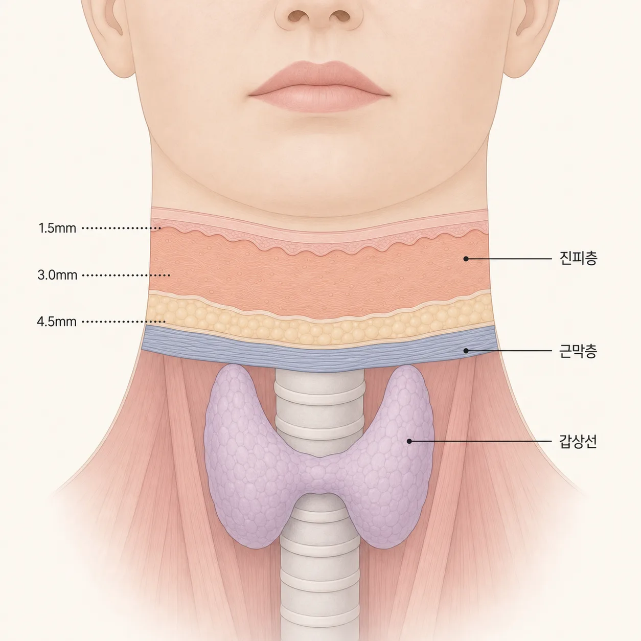 HIFU 집속 깊이와 갑상선 위치 관계