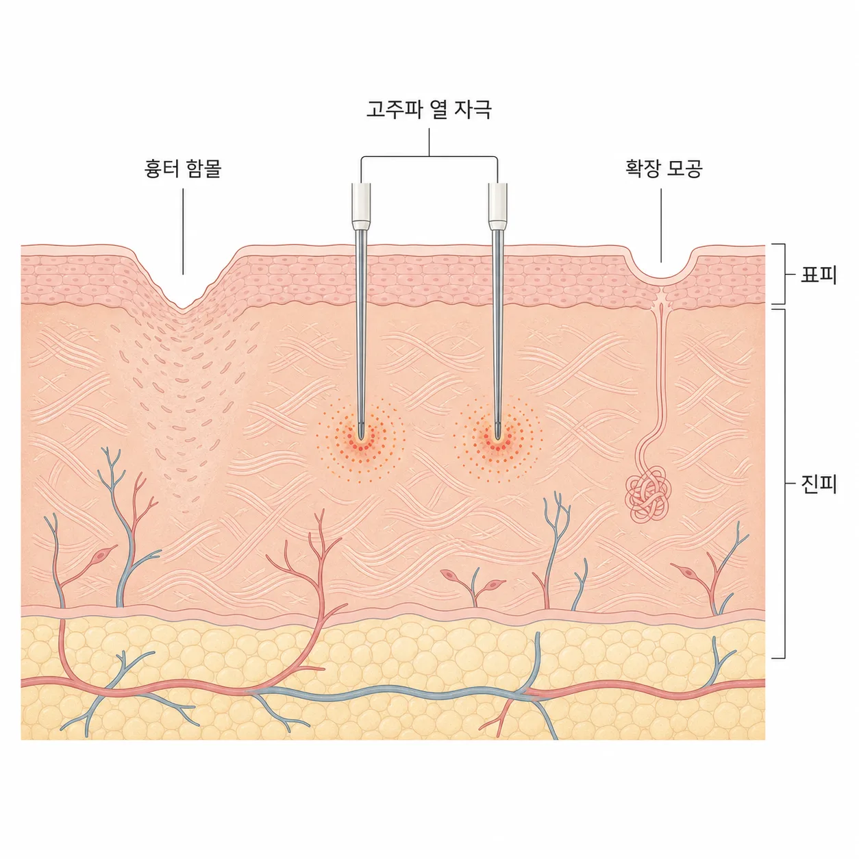 마이크로니들 RF의 진피층 작용 원리