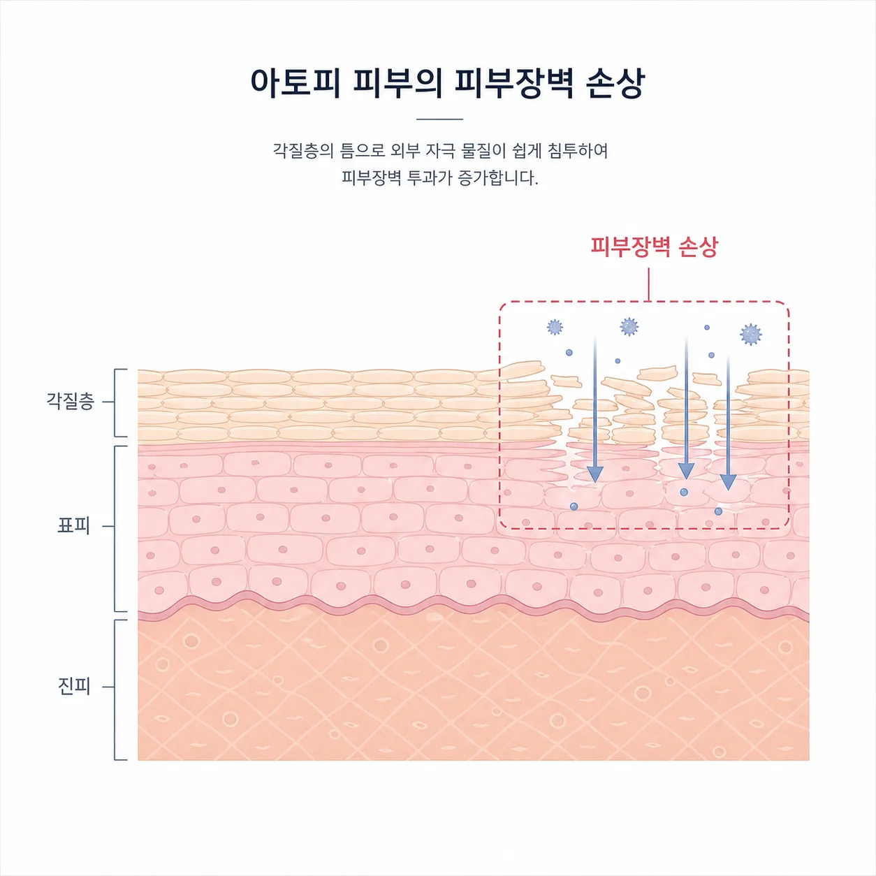 아토피 피부의 각질층 장벽 손상 구조