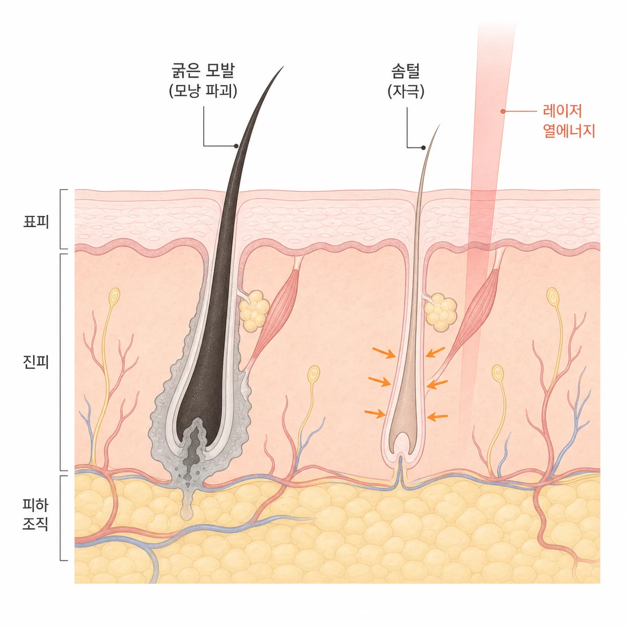 레이저 열에너지가 굵은 모낭에는 파괴 작용을, 주변 솜털에는 자극 작용을 줄 수 있어요
