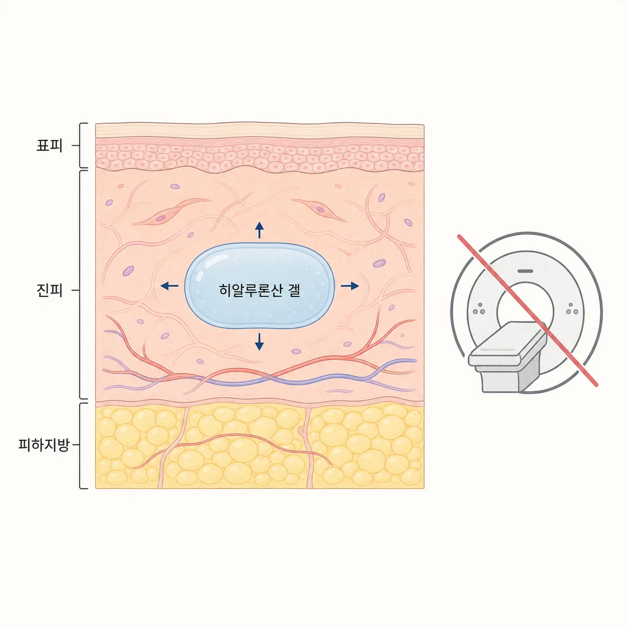 진피층 안의 히알루론산 겔 — 금속 성분 없어 MRI 자기장에 반응하지 않아요