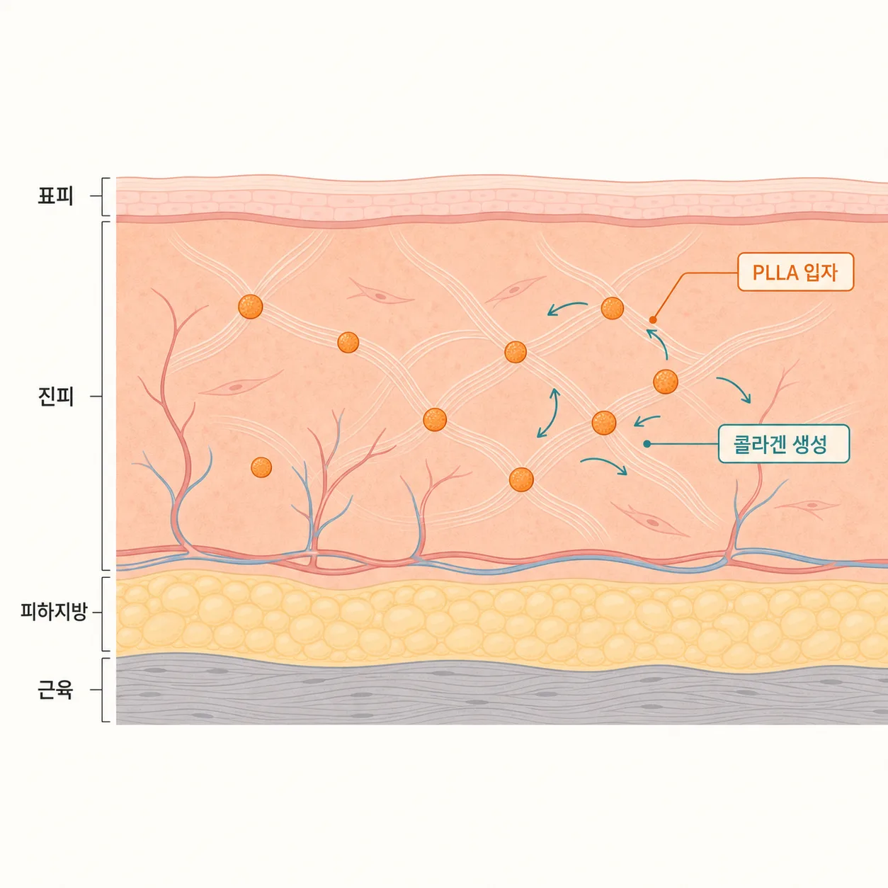 목·데콜테 피부층과 진피 내 PLLA 입자 주변 콜라겐 생성 과정