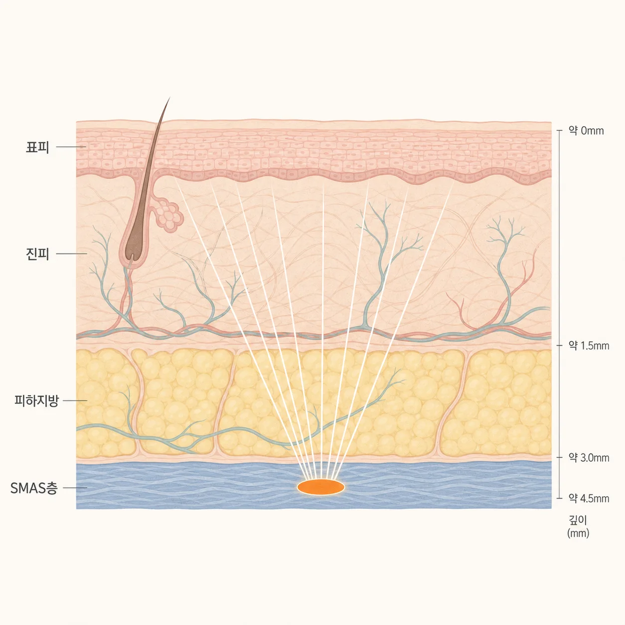 HIFU 에너지가 수렴하는 피부 층 단면 — 표피·진피·피하지방·SMAS층