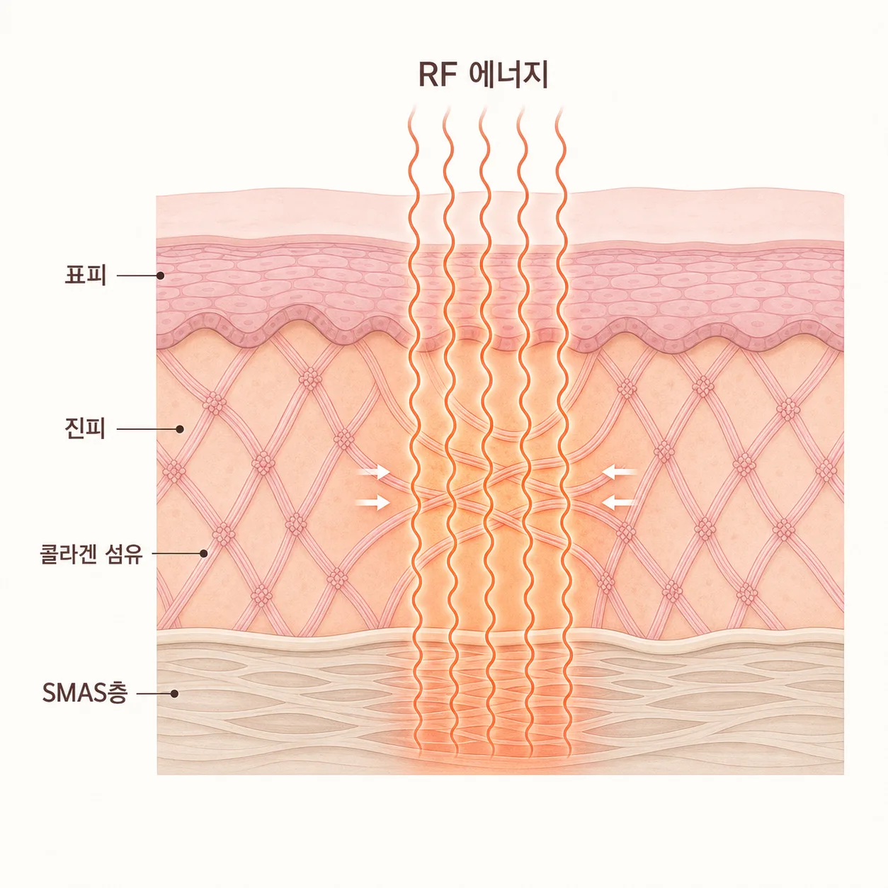 RF 에너지가 진피와 SMAS층에 도달해 콜라겐 섬유를 자극하는 단면