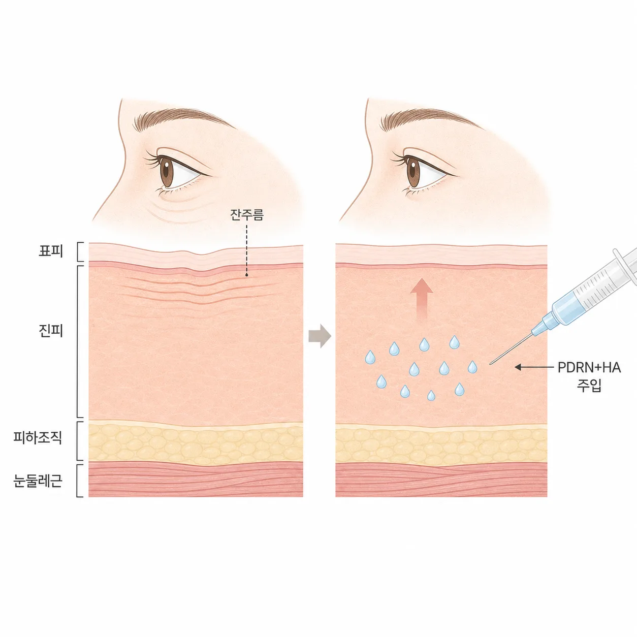 눈가 얇은 피부층과 PDRN·HA 스킨부스터가 진피에 작용하는 구조