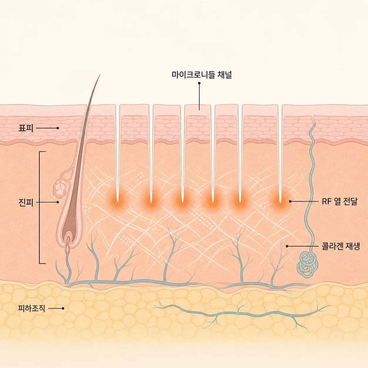 마이크로니들 RF가 표피부터 진피까지 채널을 열고 콜라겐 재생을 시작하는 구조