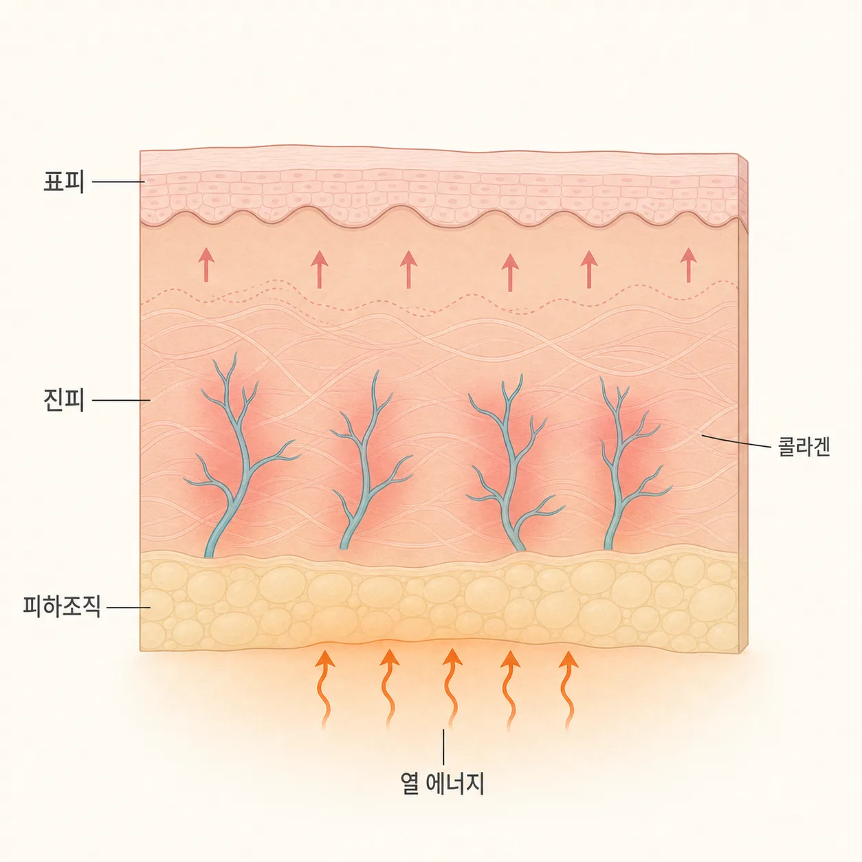 고주파 열 에너지가 진피에 전달되며 붓기와 홍조가 생기는 기전