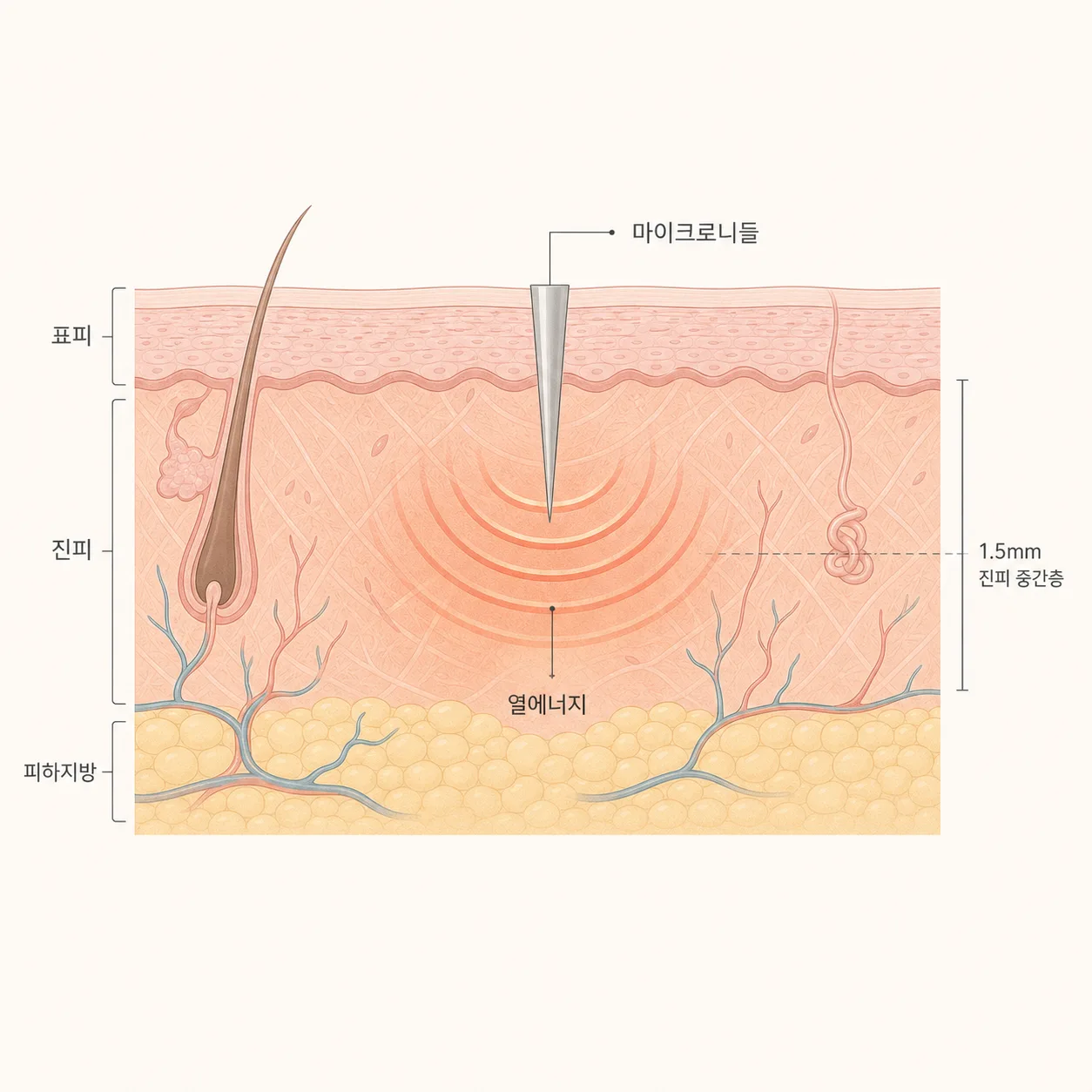 마이크로니들에서 방출된 고주파 에너지가 진피층에 열을 전달하는 경로