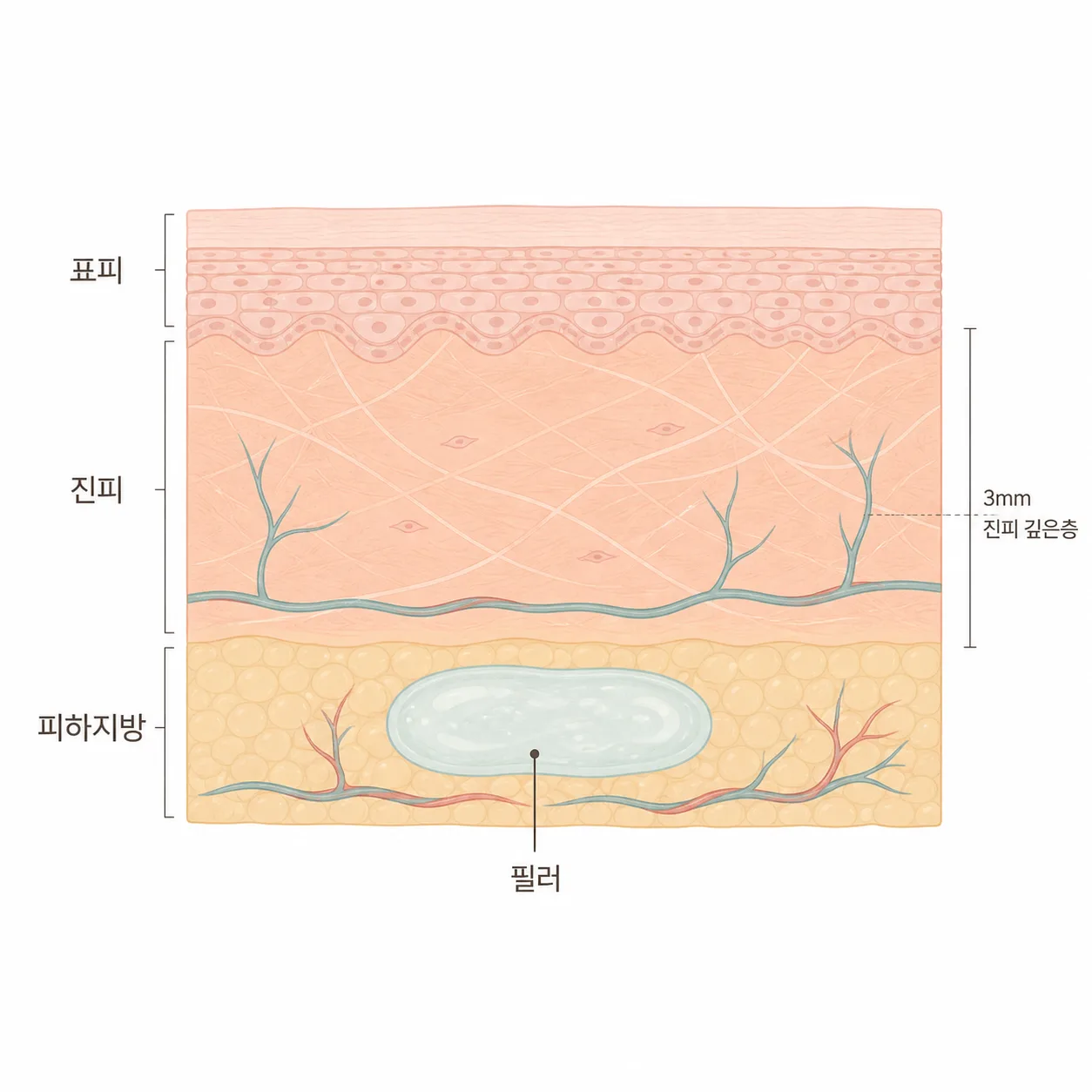 피하지방 층에 자리한 필러와 주변 미세 혈관의 모습이에요