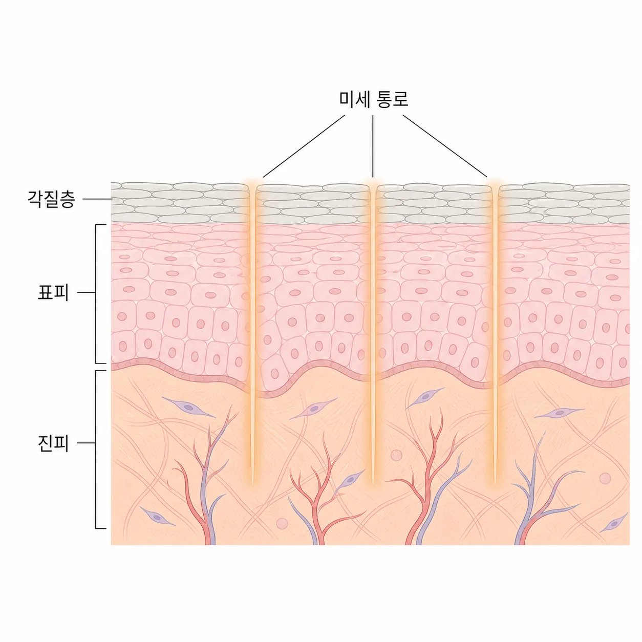 미세 통로가 열려 있는 동안 얇아지는 방어벽