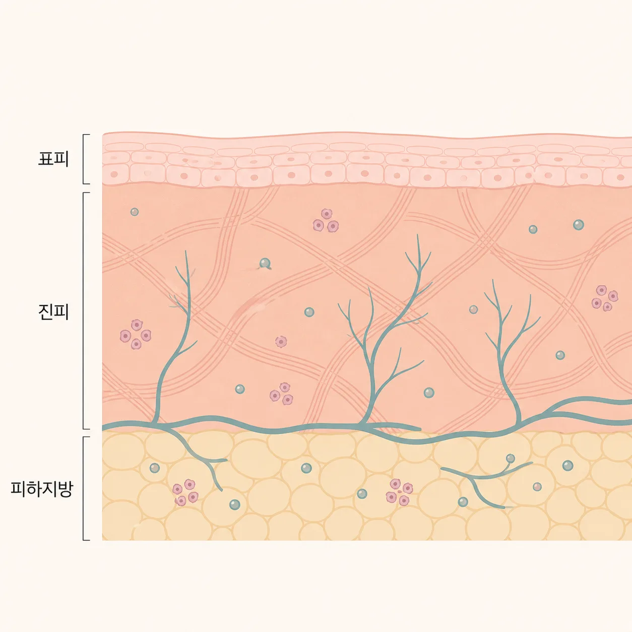 진피와 피하지방 사이에 남은 입자 주변으로 새 조직이 만들어지는 층