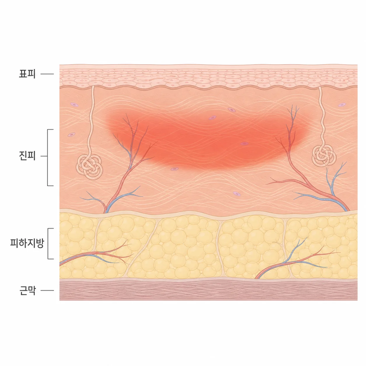 진피 안쪽에 열이 모이는 자리와 그 아래 지방·근막층