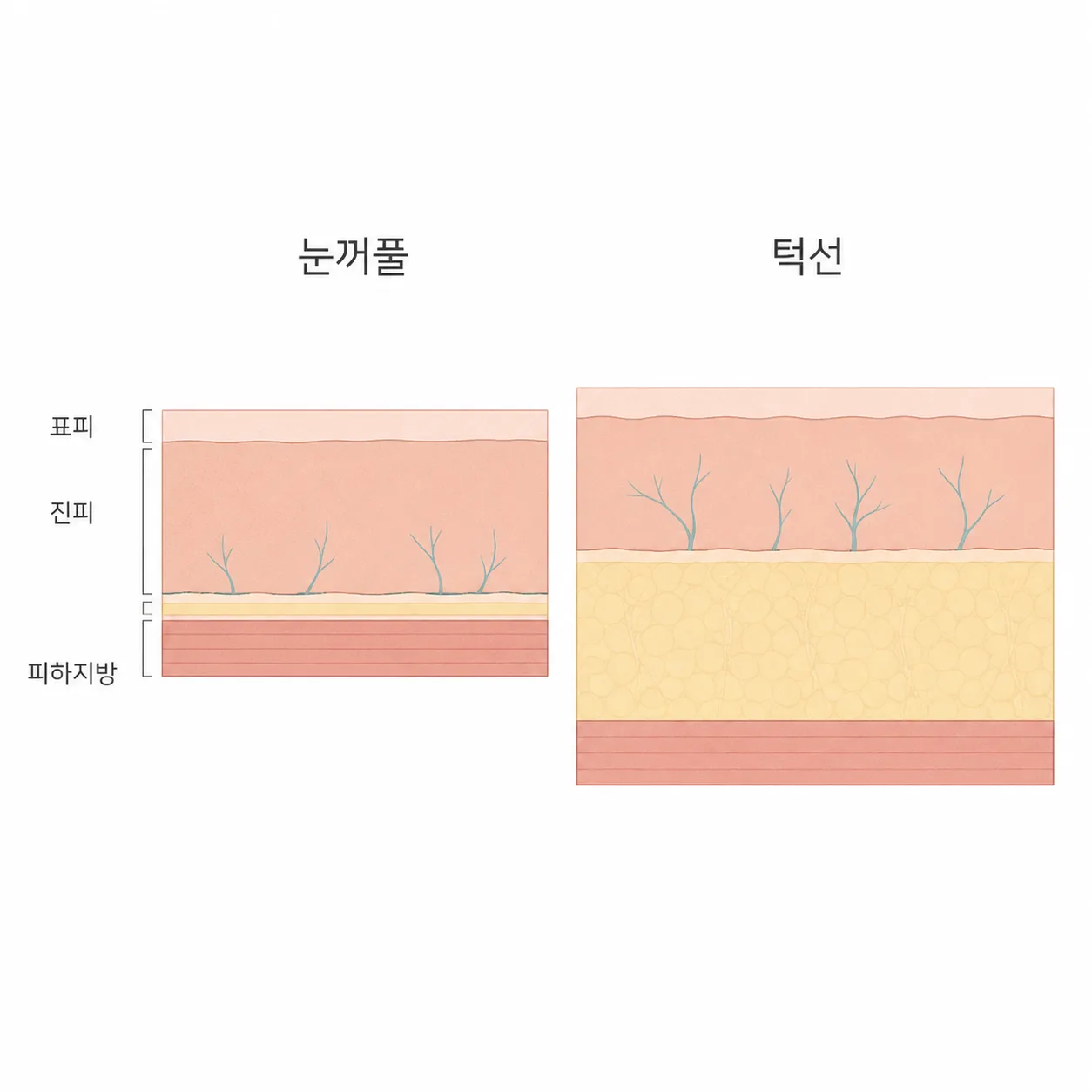 얇은 눈꺼풀 단면과 두꺼운 턱선 단면을 같은 배율로 비교