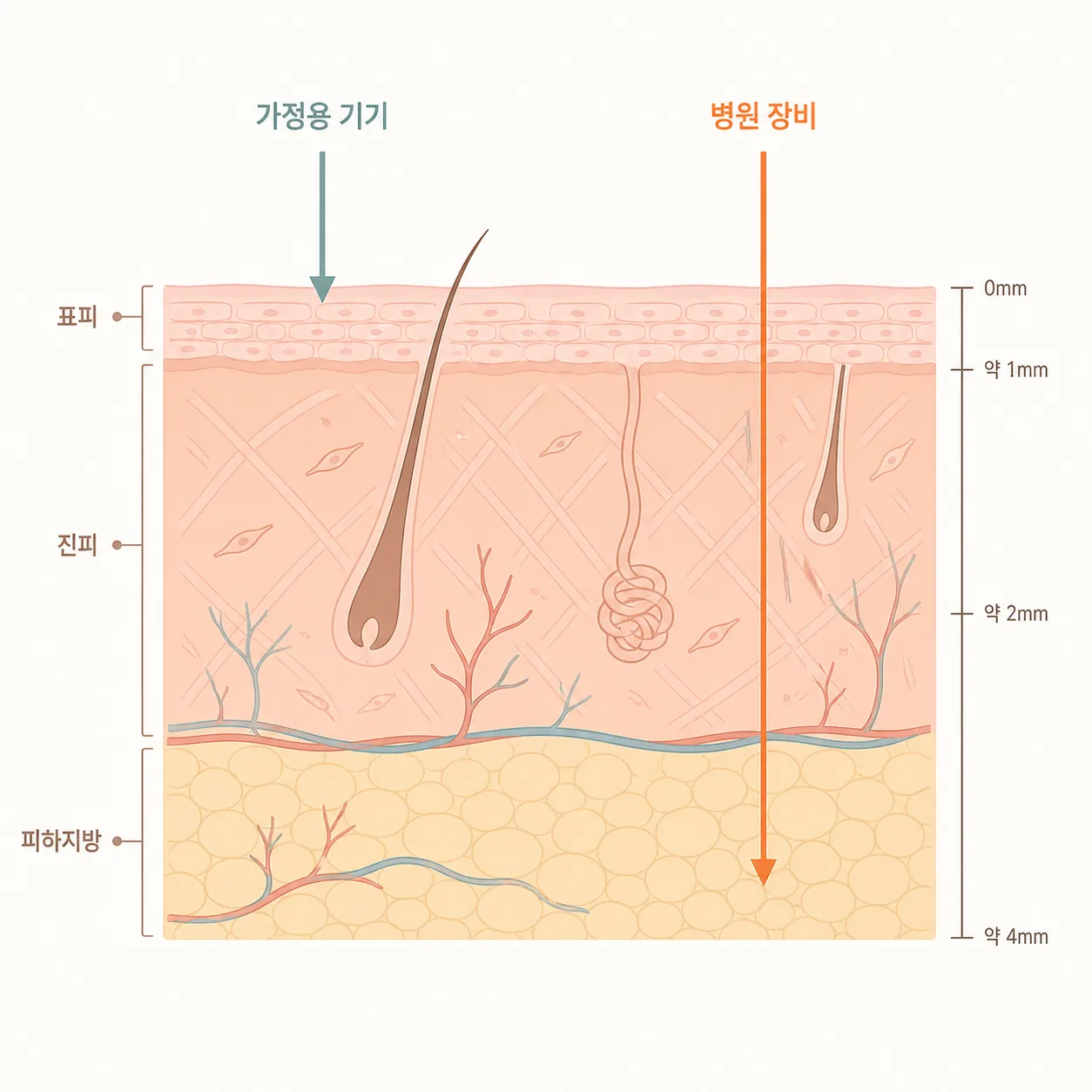 가정용 기기와 병원 장비가 닿는 깊이를 같은 단면에서 비교