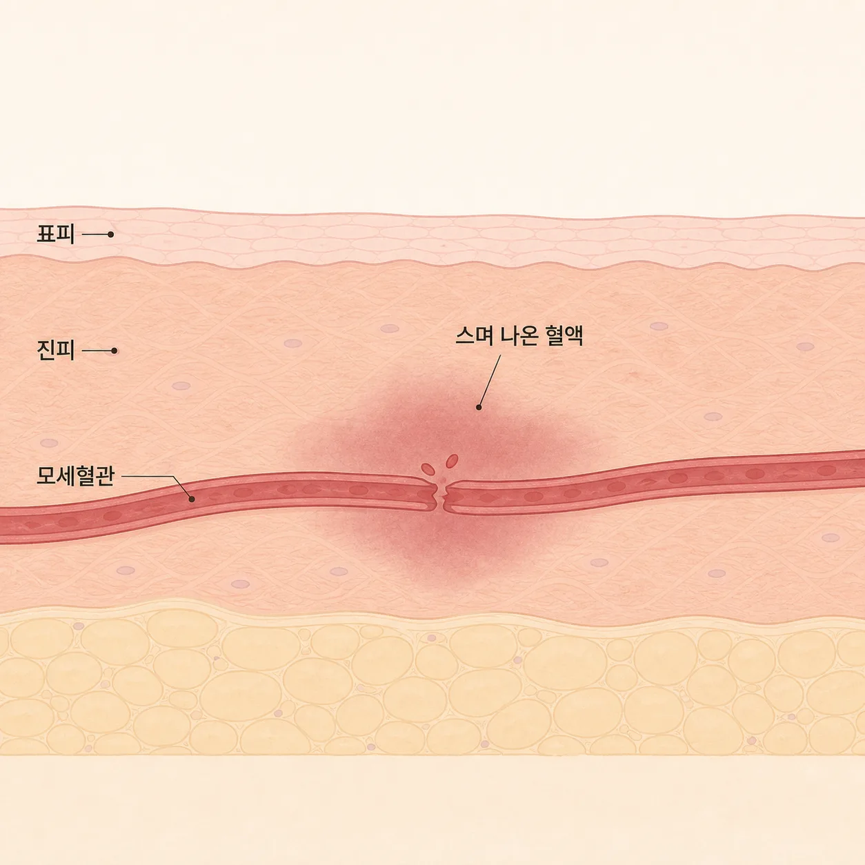 멍은 모세혈관에서 새어 나온 혈액이 조직에 퍼진 상태예요