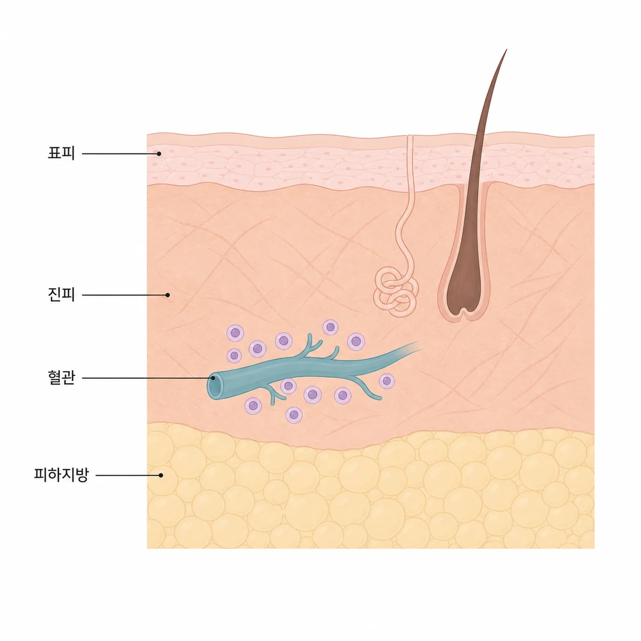 감염 반응 중인 피부 층의 상태