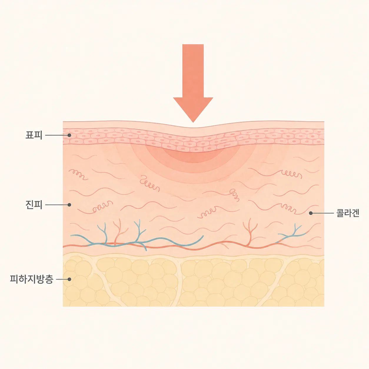 온다 직후 진피에서 진행되는 반응과 바깥에서 더해지는 압력
