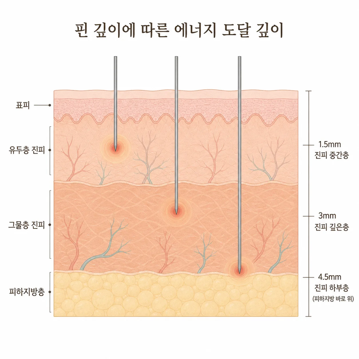니들 깊이에 따라 열이 생기는 지점이 달라지는 모습